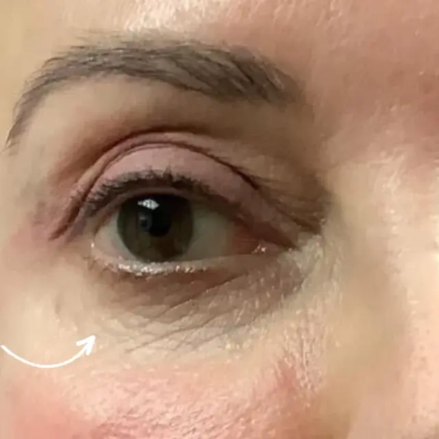 Laser Skin Resurfacing before at Miami Plastic Surgery in Miami, FL