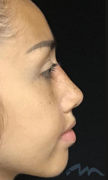 Miami Plastic Surgery rhinoplasty after — Miami, FL