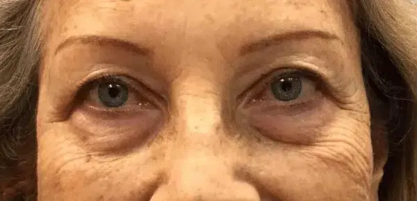 Blepharoplasty result at Miami Plastic Surgery in Miami, FL