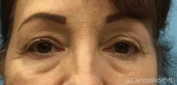 Miami Plastic Surgery blepharoplasty result — Miami, FL