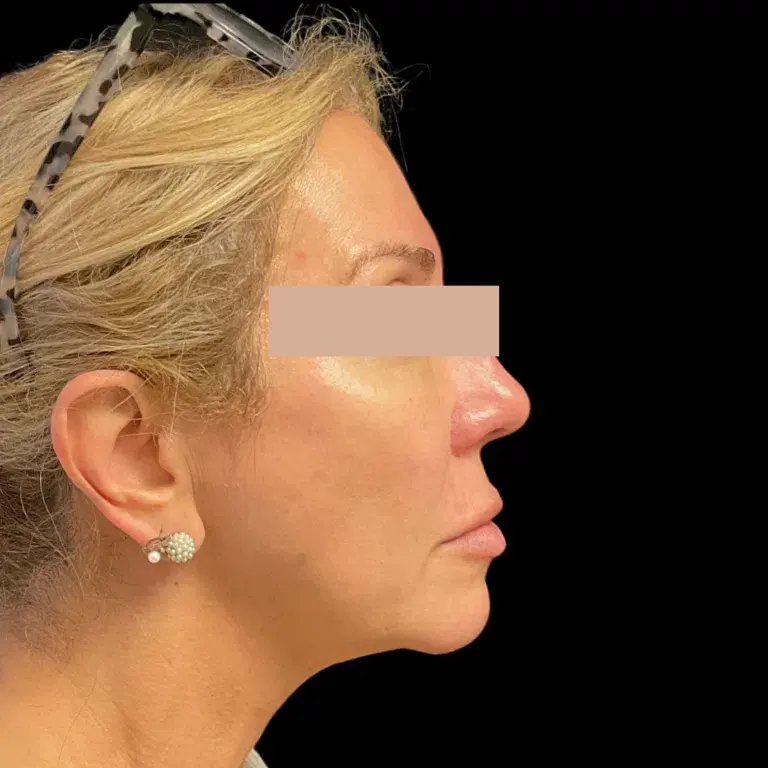 Miami Plastic Surgery skin tightening after — Miami, FL