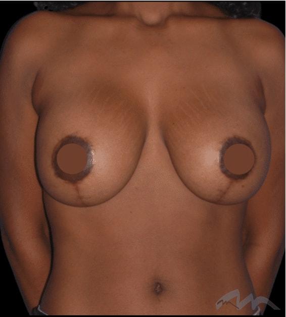 Miami Plastic Surgery breast lift after — Miami, FL