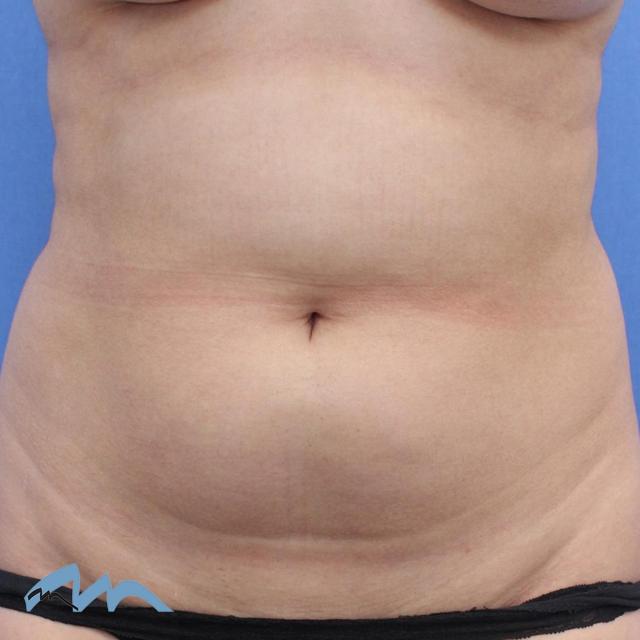 Liposuction before at Miami Plastic Surgery in Miami, FL