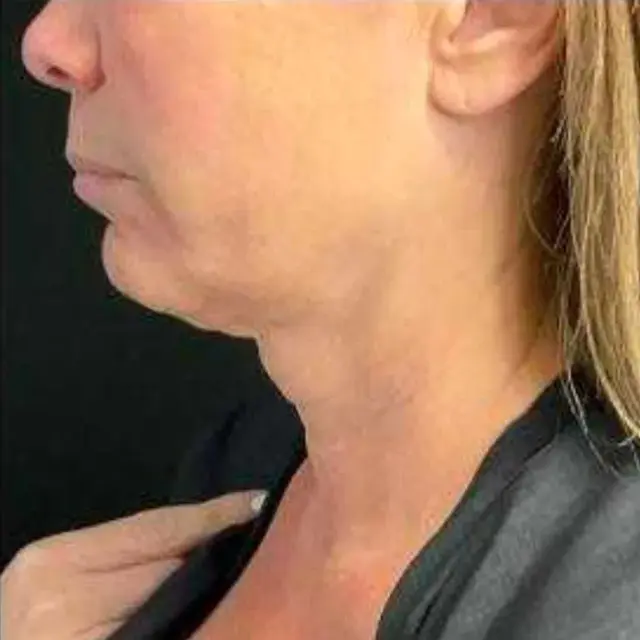 Microneedling before at Miami Plastic Surgery in Miami, FL