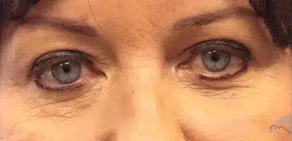 Miami Plastic Surgery blepharoplasty result — Miami, FL