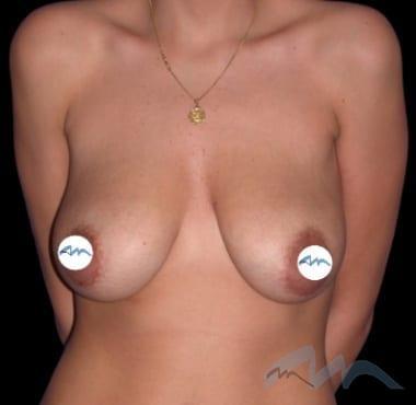 Breast Lift before at Miami Plastic Surgery in Miami, FL