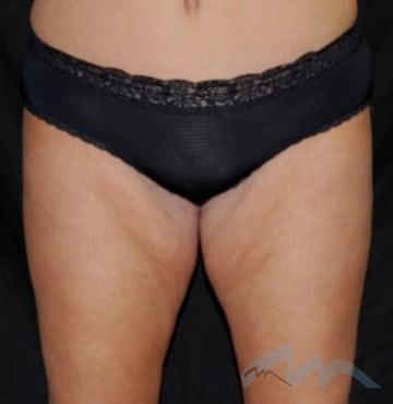 Thigh Lift before at Miami Plastic Surgery in Miami, FL