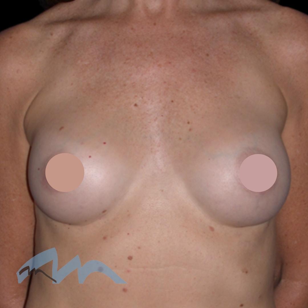 Miami Plastic Surgery breast augmentation after — Miami, FL
