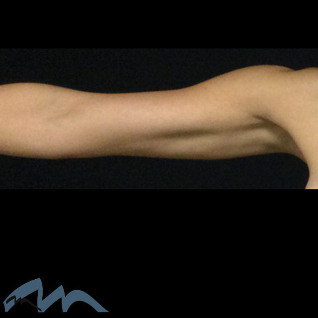 Arm Lift after at Miami Plastic Surgery in Miami, FL