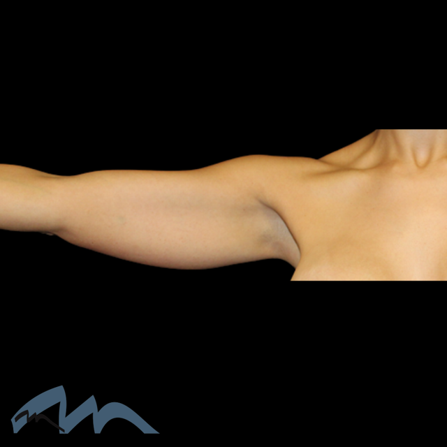 Arm Lift before at Miami Plastic Surgery in Miami, FL