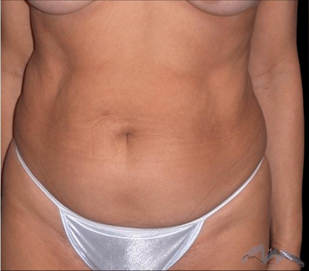 Liposuction before at Miami Plastic Surgery in Miami, FL