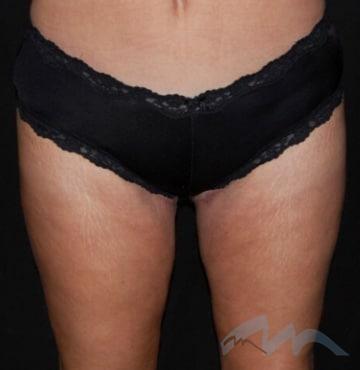 Thigh Lift after at Miami Plastic Surgery in Miami, FL