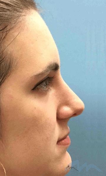 Miami Plastic Surgery rhinoplasty after — Miami, FL