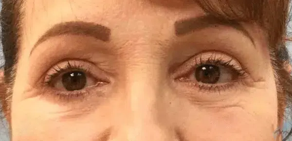 Miami Plastic Surgery blepharoplasty result — Miami, FL