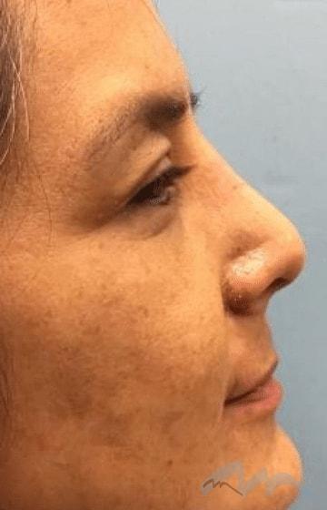 Miami Plastic Surgery rhinoplasty after — Miami, FL