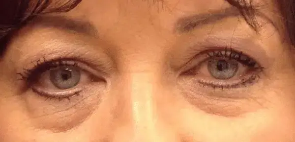Miami Plastic Surgery blepharoplasty result — Miami, FL