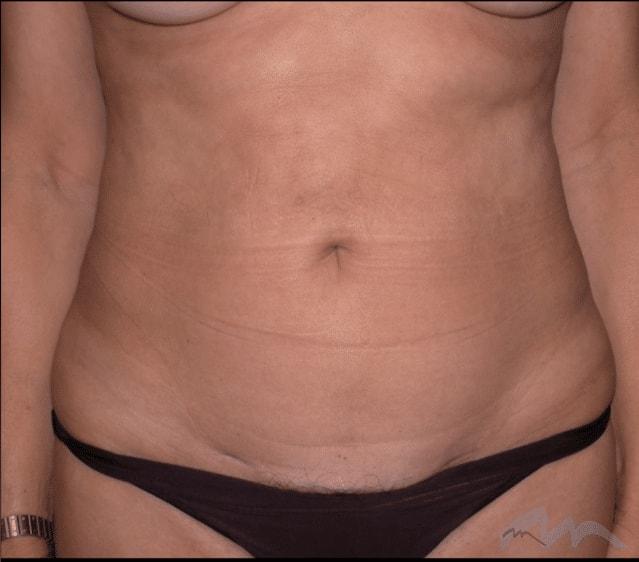 Liposuction after at Miami Plastic Surgery in Miami, FL