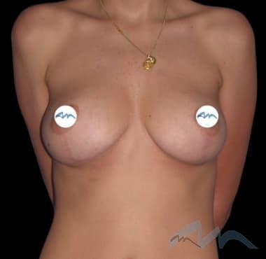 Breast Lift after at Miami Plastic Surgery in Miami, FL