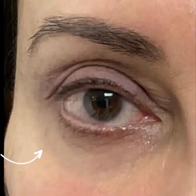 Laser Skin Resurfacing after at Miami Plastic Surgery in Miami, FL