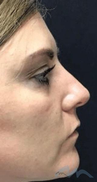 Functional Rhinoplasty before at Miami Plastic Surgery in Miami, FL