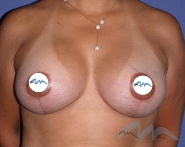 Miami Plastic Surgery breast lift after — Miami, FL