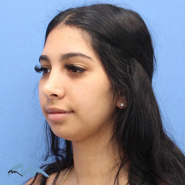 Rhinoplasty after at Miami Plastic Surgery in Miami, FL