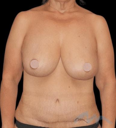 Mommy Makeover after at Miami Plastic Surgery in Miami, FL