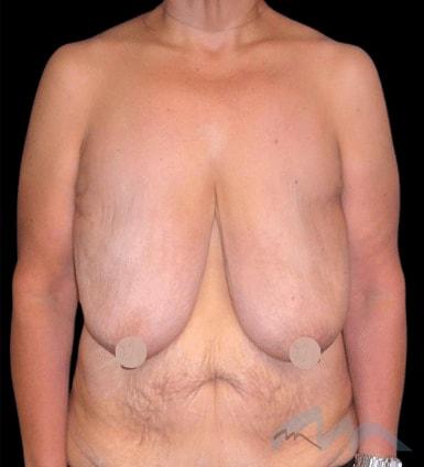 Mommy Makeover before at Miami Plastic Surgery in Miami, FL