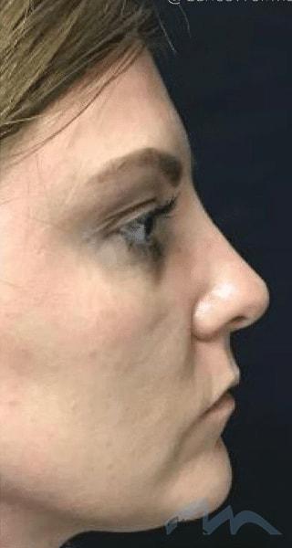 Functional Rhinoplasty after at Miami Plastic Surgery in Miami, FL