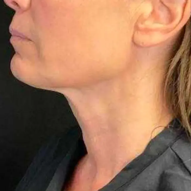 Microneedling after at Miami Plastic Surgery in Miami, FL