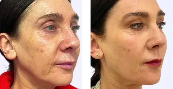 Facelift result at KHROM MEDSPA & WELLNESS in Brooklyn, NY