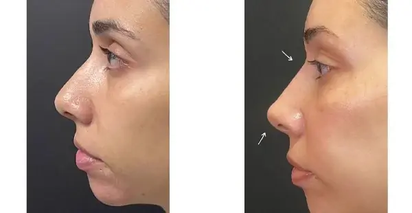 Rhinoplasty result at KHROM MEDSPA & WELLNESS in Brooklyn, NY