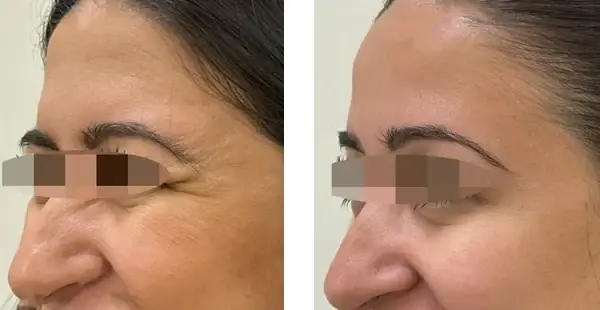 Botox result at KHROM MEDSPA & WELLNESS in Brooklyn, NY