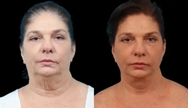 Deep Plane Facelift result at Marietta Plastic Surgery in Marietta, GA
