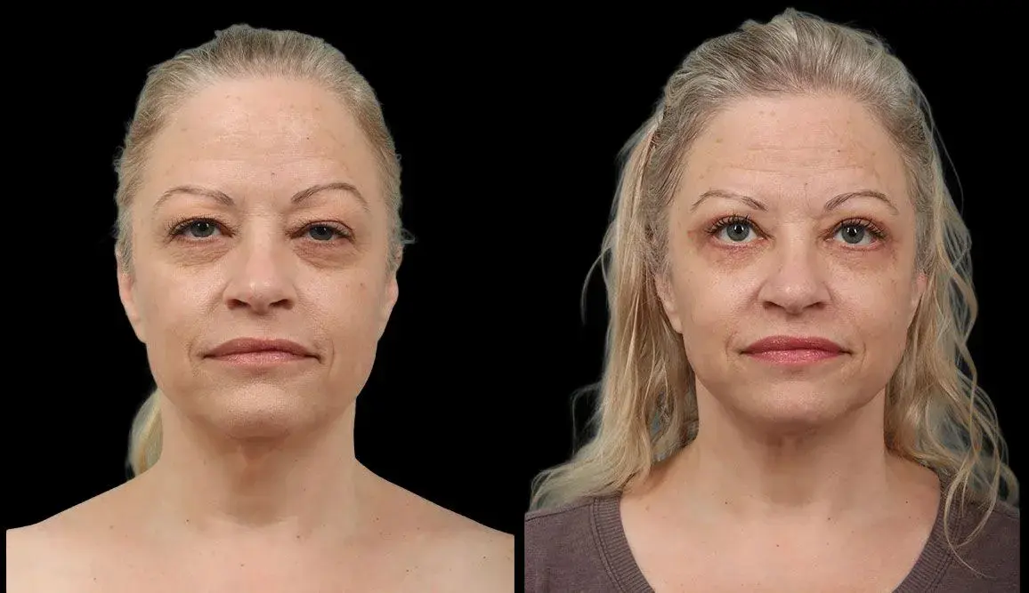 Marietta Plastic Surgery blepharoplasty result — Marietta, GA