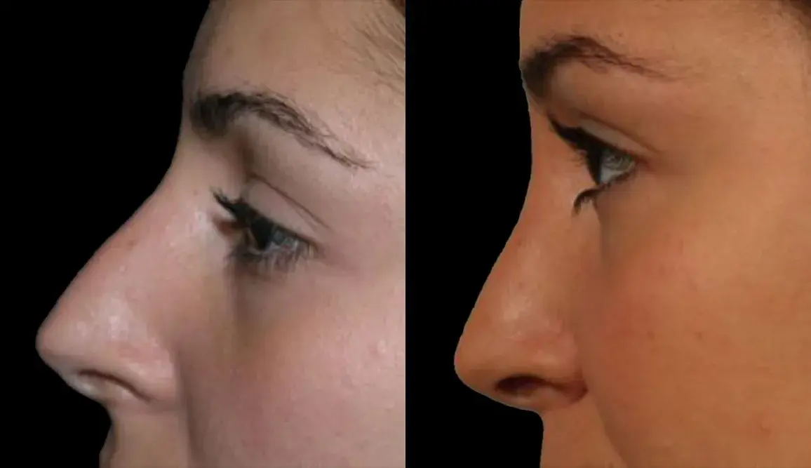 Marietta Plastic Surgery rhinoplasty result — Marietta, GA