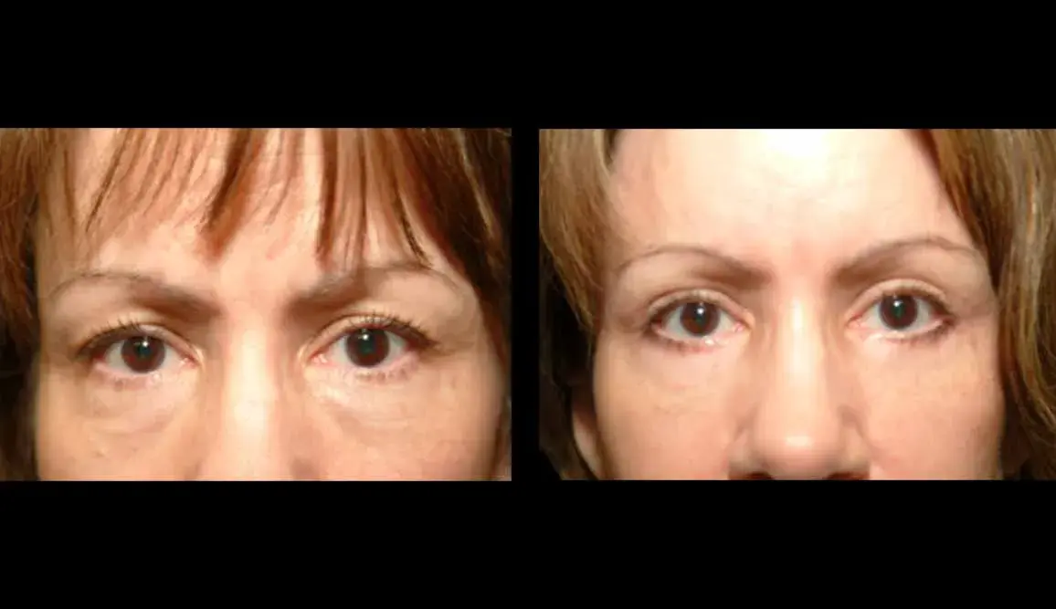 Marietta Plastic Surgery blepharoplasty result — Marietta, GA