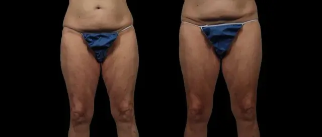 Thigh Lift result at Marietta Plastic Surgery in Marietta, GA