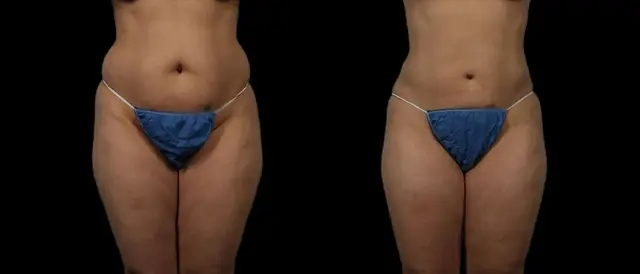 Liposuction result at Marietta Plastic Surgery in Marietta, GA