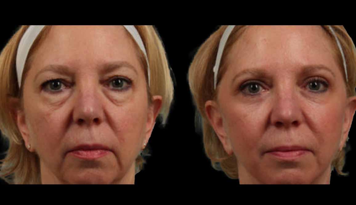Marietta Plastic Surgery blepharoplasty result — Marietta, GA