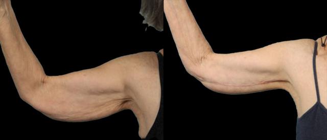 Thigh Lift result at Marietta Plastic Surgery in Marietta, GA