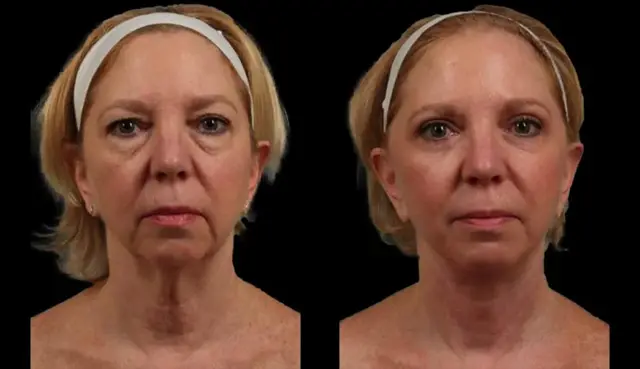 Deep Plane Facelift result at Marietta Plastic Surgery in Marietta, GA