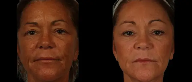Chemical Peel result at Marietta Plastic Surgery in Marietta, GA