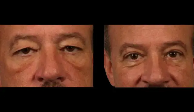 Blepharoplasty result at Marietta Plastic Surgery in Marietta, GA