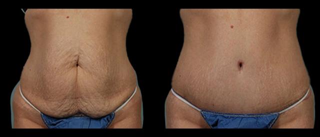 Tummy Tuck result at Marietta Plastic Surgery in Marietta, GA