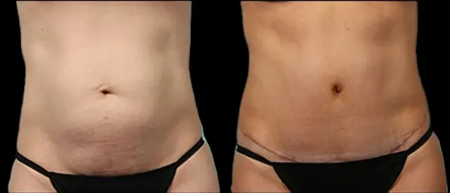 Tummy Tuck result at Marietta Plastic Surgery in Marietta, GA