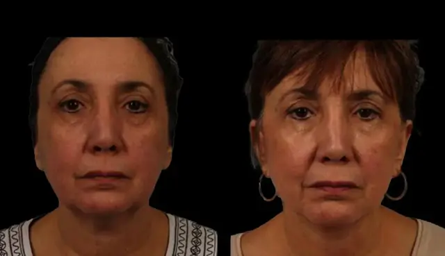 Deep Plane Facelift result at Marietta Plastic Surgery in Marietta, GA