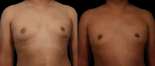 Gynecomastia Surgery result at Marietta Plastic Surgery in Marietta, GA