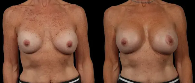 Fat Transfer Breast Augmentation result at Marietta Plastic Surgery in Marietta, GA