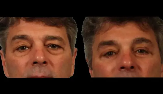 Blepharoplasty result at Marietta Plastic Surgery in Marietta, GA